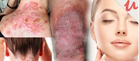 Certificate In Skin Disorders Alternative Therapy Treatment