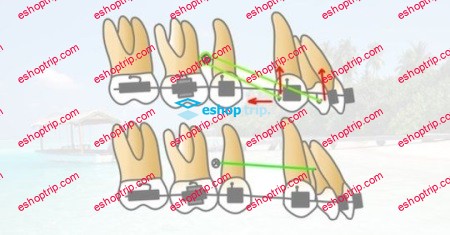 Mini Implants in Orthodontics