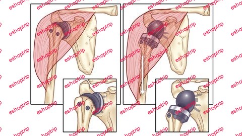 What To Expect After A Total Shoulder Replacement