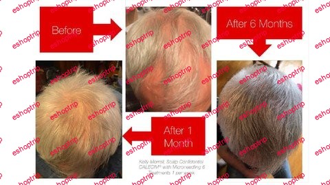 Microneedling For Hairloss With Stem Cells