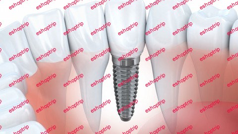 Dental Implants A Prosthetic Makeover