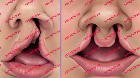 Cleft Lip And Palate A Dental Deformity