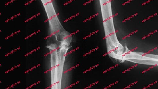 Radiology X Ray of Elbow and Forearm